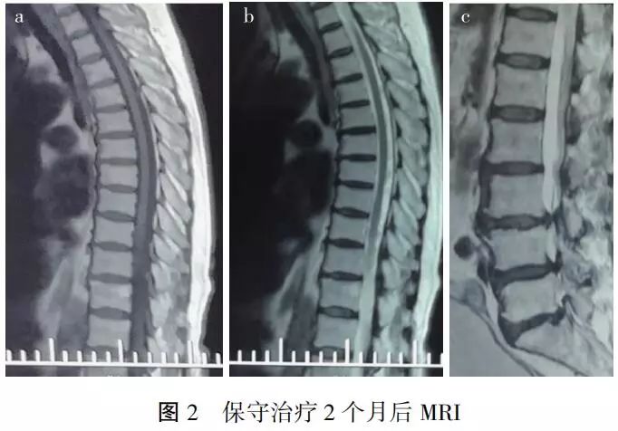 【病例分析】自发性椎管内硬膜外血肿保守治疗1例报告