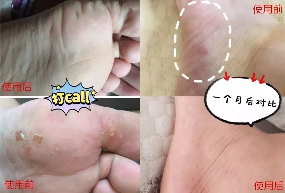 专治脚气的神奇药,十多年的脚气三味中药一招搞定