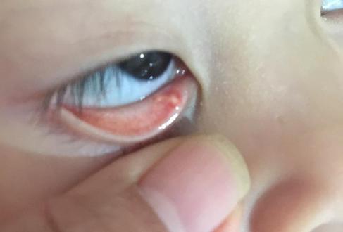 戴美瞳为什么会长结石,眼睛也会长结石吗