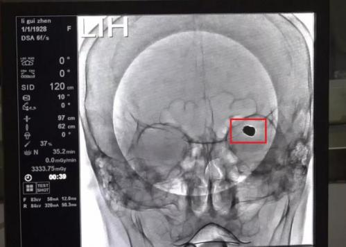 吉林省哪个医院做脑动脉瘤最好,吉林省神经精神病医院精神科