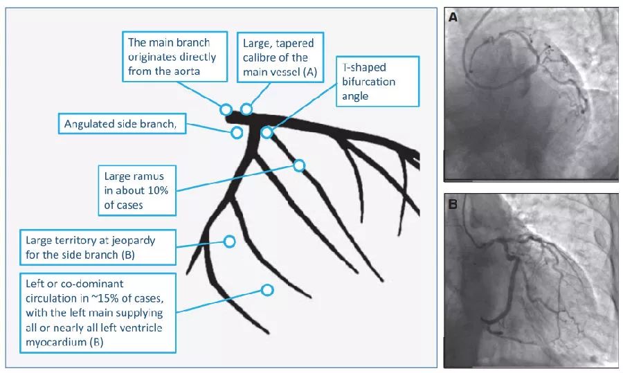 EHJ综述：左主干病变治疗更新，最新欧美指南将如何推荐？｜热点聚焦