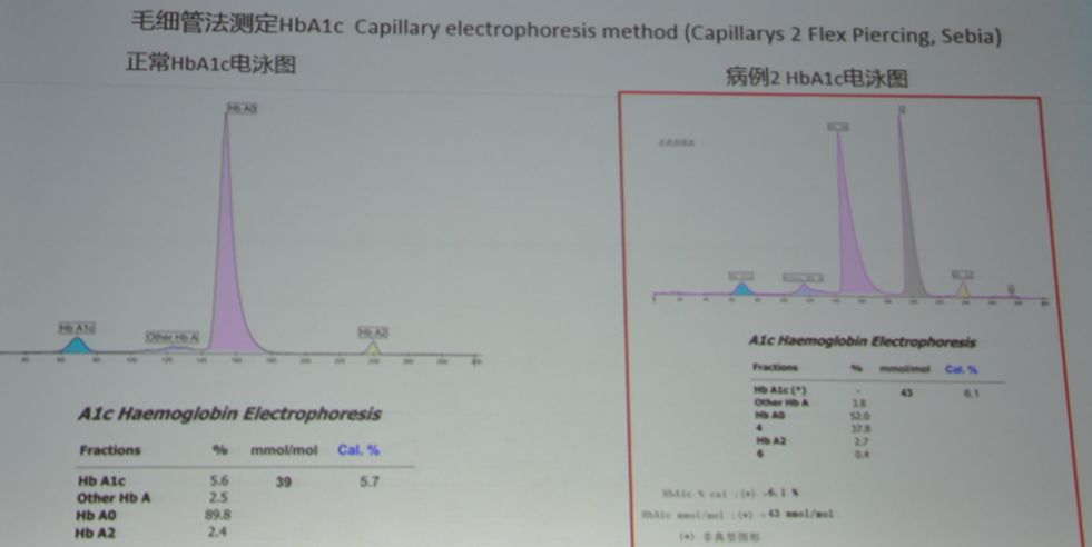 糖化血红蛋白测定会有误差吗,糖化血红蛋白分析误差大吗