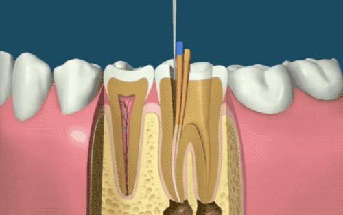根管治疗没那么可怕,根管治疗有什么意义吗
