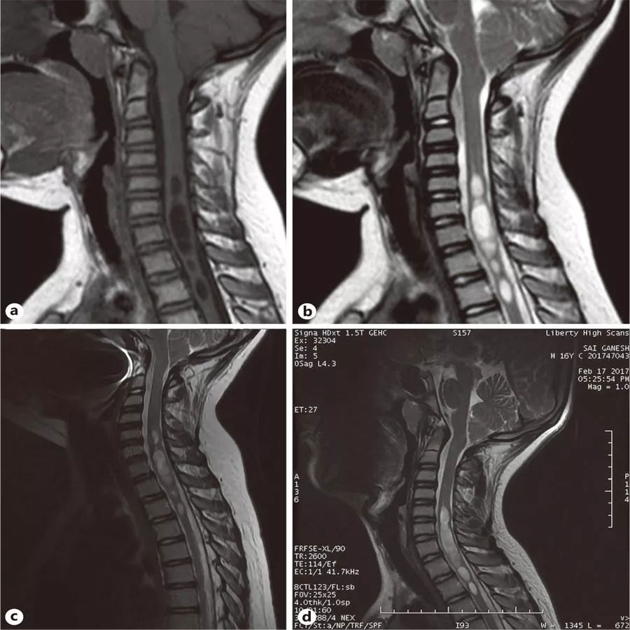 Chiari畸形1型伴脊髓空洞症能自愈吗？