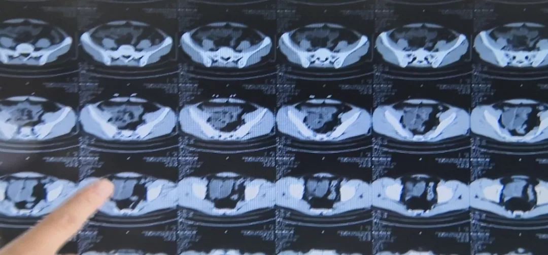 常州腹泻,常州拉肚子止泻药