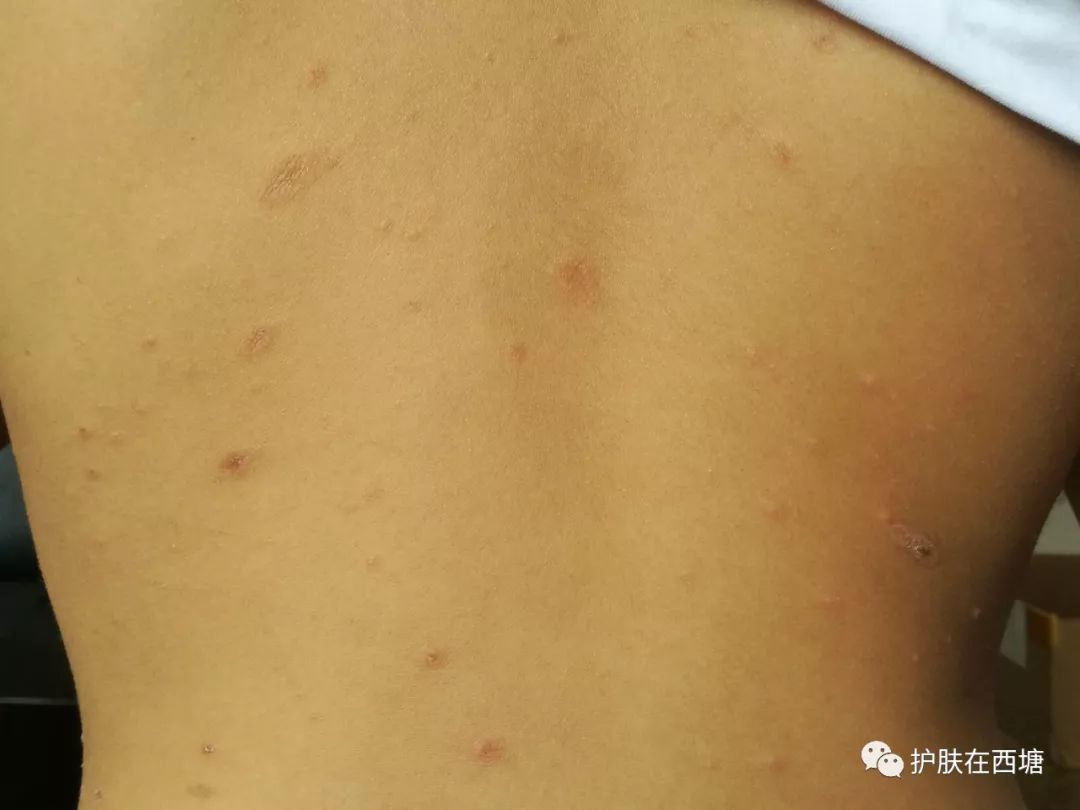 常见面部皮肤病,三脂溢性皮炎