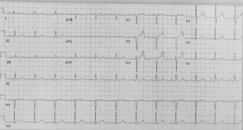 心电图上一个小格代表什么,心电图上有小波动你会怎么样