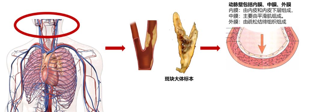 动脉硬化最新检查手段,动脉硬化最佳检查方法