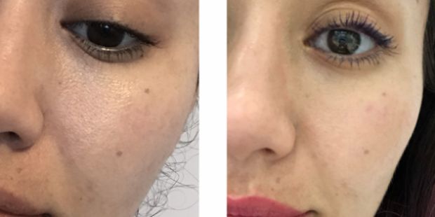 皮肤粗糙暗沉毛孔粗要做什么医美,真正改变毛孔的医美