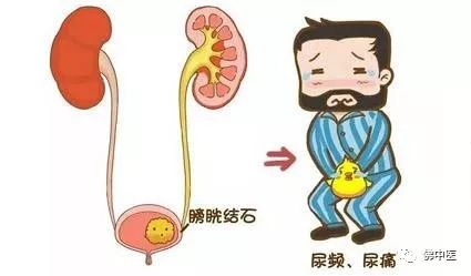 70岁老人前列腺肥大膀胱结石,膀胱巨大结石的症状
