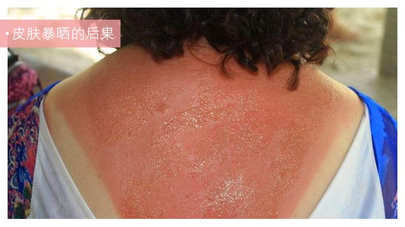 晒后急救小妙招自制面膜,晒后急救处理方法