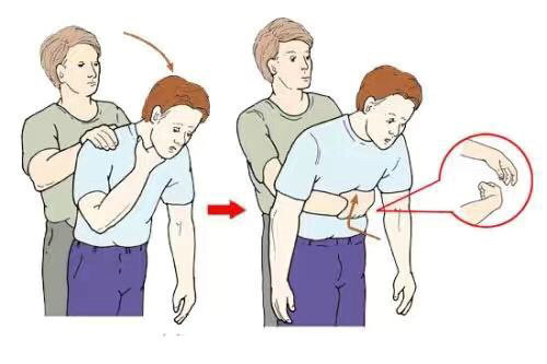 小孩被笔帽异物卡住急救方法,孩子误吞笔帽抢救视频