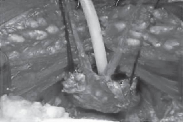 前列腺癌手术根治需切除睾丸吗,前列腺癌是切除还是保守治疗