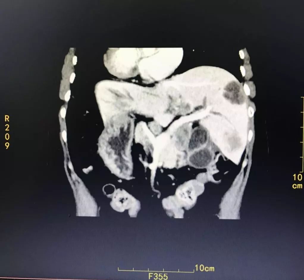 镜面人内脏移植,镜面人胆囊切除