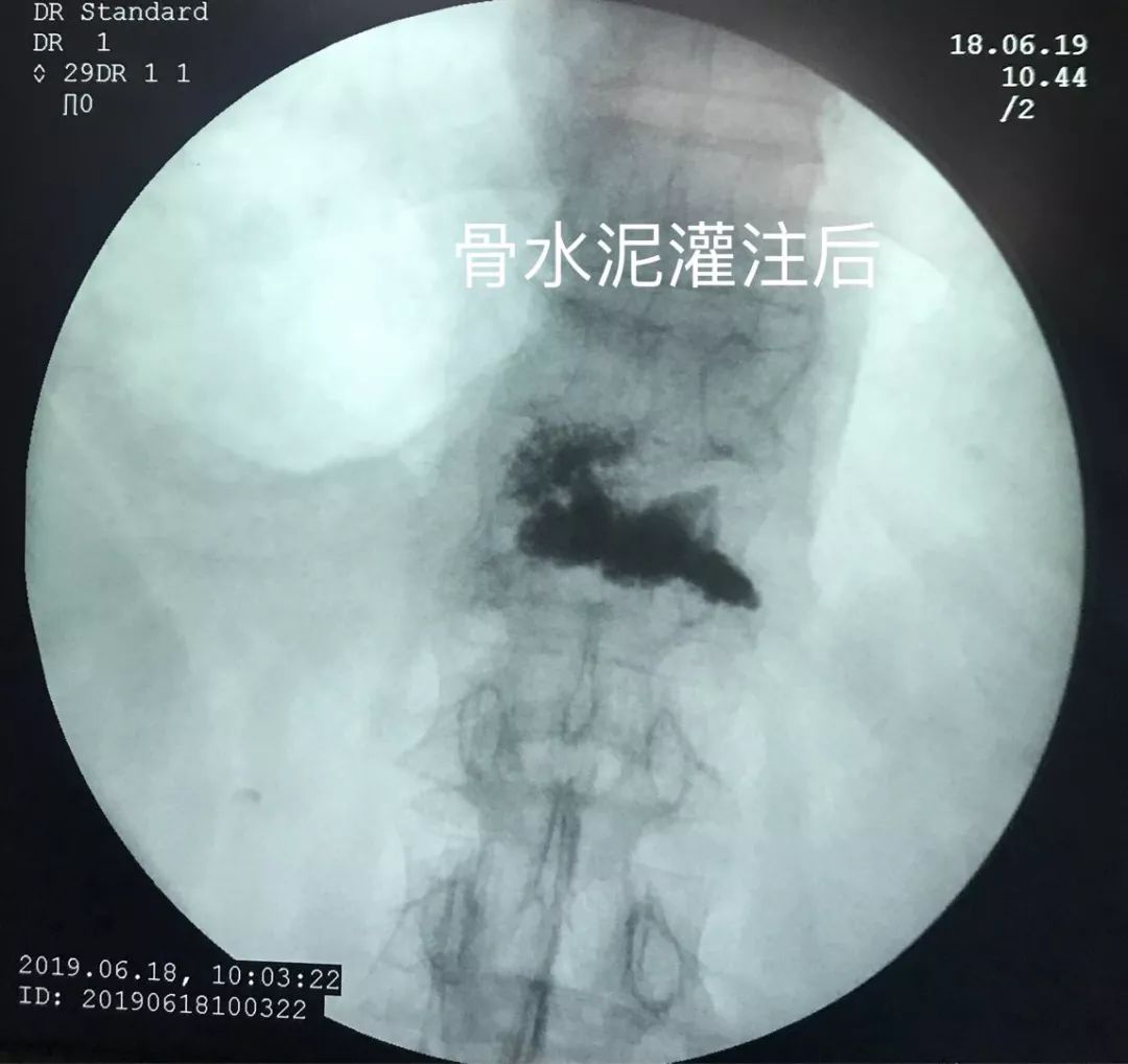 骨科科普压缩性骨折,陈旧性压缩骨折和新近压缩骨折