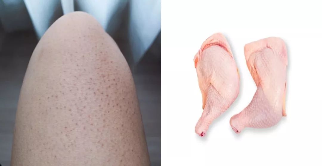 夏天鸡皮肤容易发痒怎么办,夏天到了恼人的鸡皮肤该怎么办