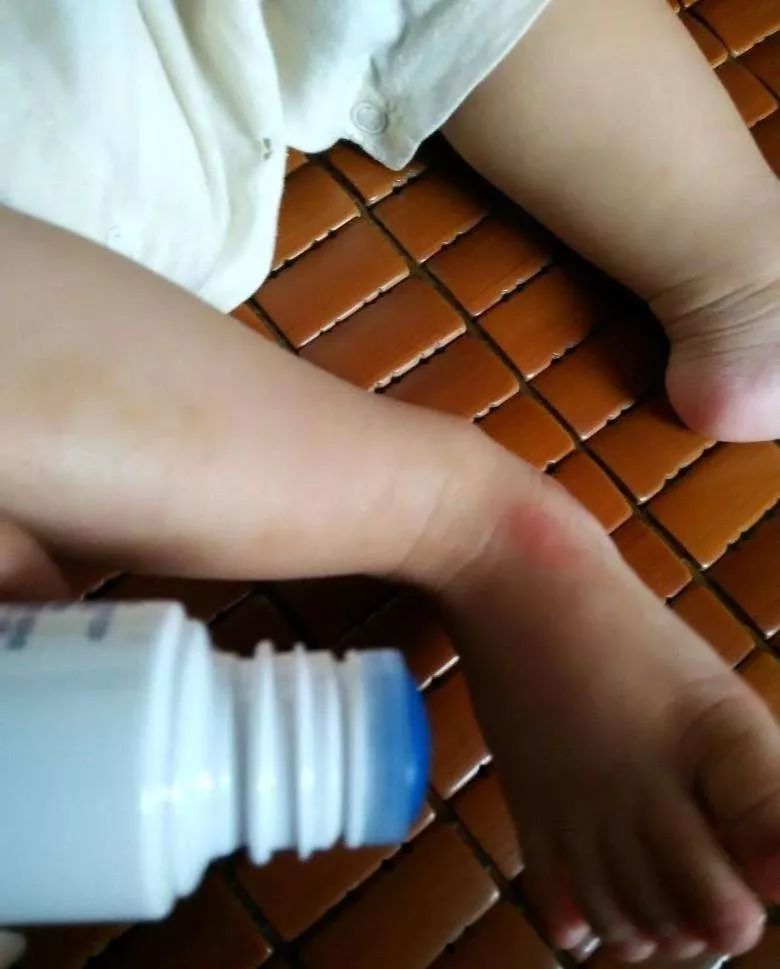 10个月宝宝手肿得很大,10个月宝宝手肿了