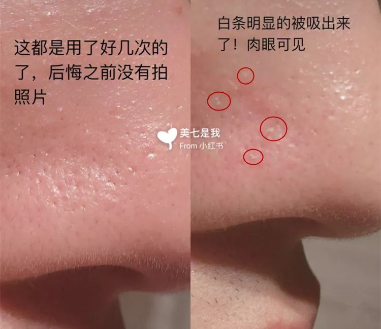 草莓鼻救星怎么治疗,草莓鼻去黑头神器视频