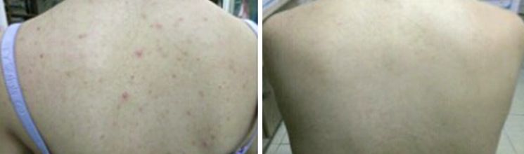 教你1分钟清除99%的脸上螨虫,10秒祛螨虫的药膏