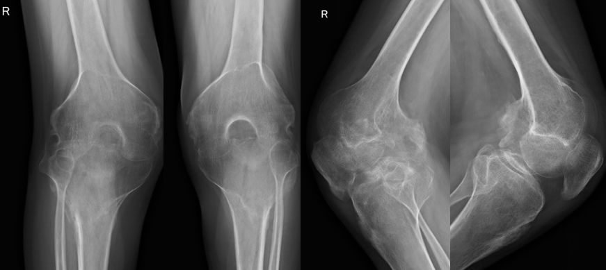 骨道堂治疗强直性脊柱炎效果,御医堂治疗强直性脊柱炎