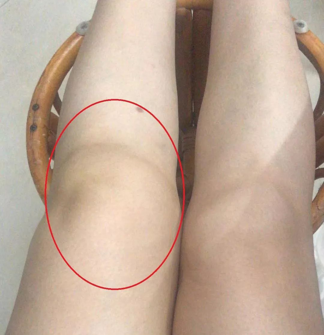膝盖急性损伤肿过大腿，这样处理后她第二天竟好了八成
