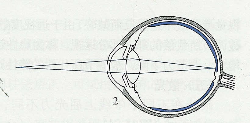 医生说孩子眼球不正常,医生诊断屈光不正是什么意思