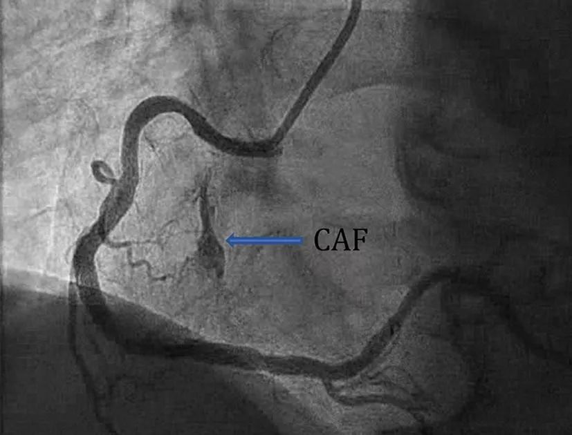 冠状动脉瘘是怎么回事,冠状动脉瘘原因