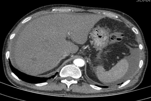 土三七中毒治好后肝能恢复正常吗,土三七中毒所致的肝损害的治疗