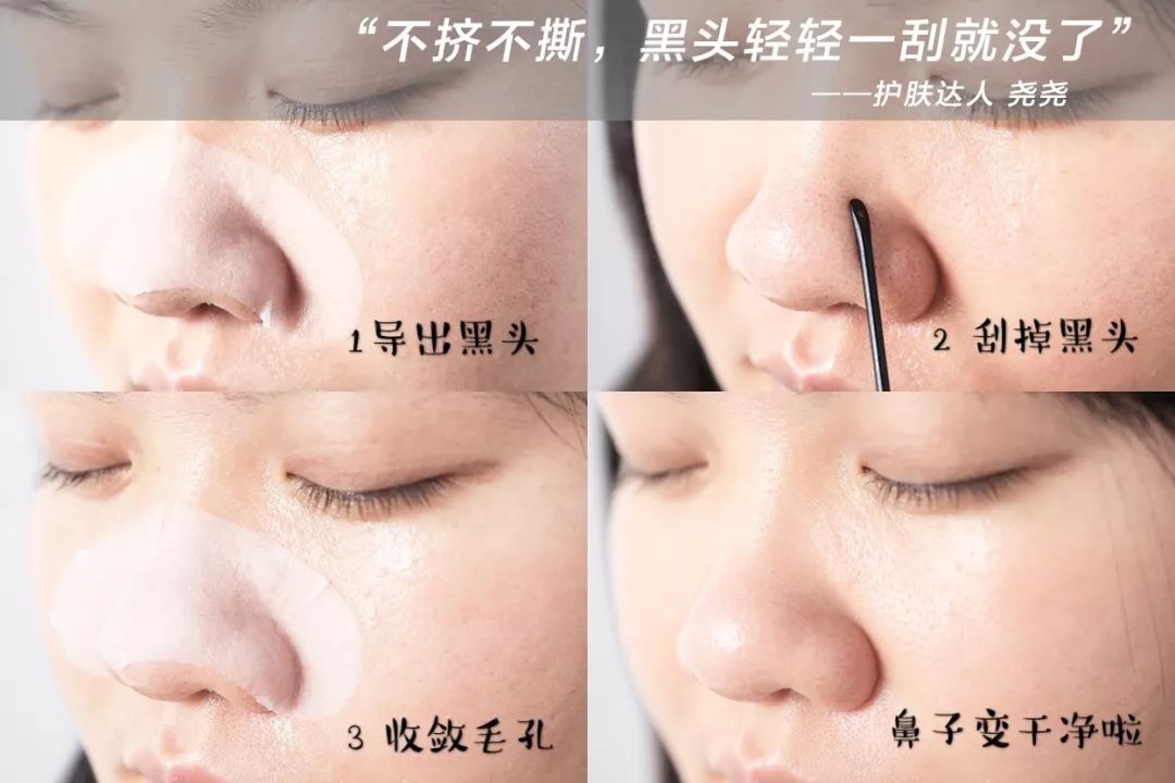 超级黑头正确处理方法,黑头别膨胀3招把你刷光光