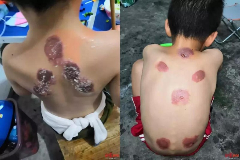 三伏贴真的有那么好的效果吗,三伏贴的优缺点