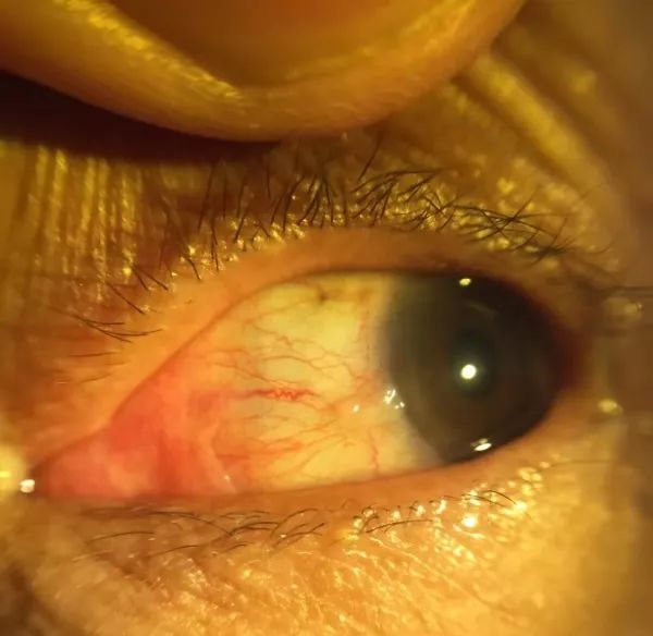 老人眼底长黄斑,80岁老人眼睛黄斑变性