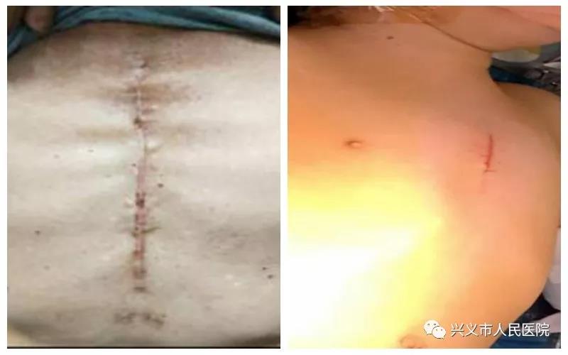 兴义市医院心胸大血管外科成功施行黔西南州首例微创心脏手术