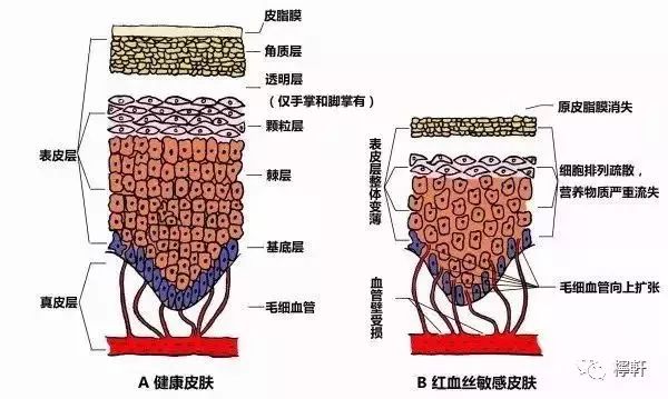新生儿皮肤红血丝明显,皮肤突然出现一点红血丝怎么回事