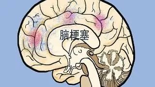 脑梗塞术后一个月康复处方,脑梗塞中药处方大全