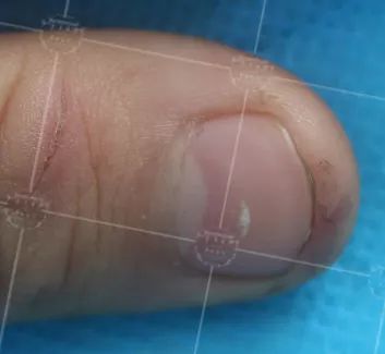 灰指甲致癌吗,灰指甲美甲的禁忌