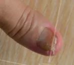 灰指甲美甲处理,灰指甲霉菌感染致癌