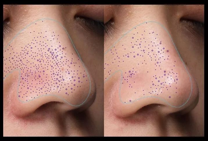 超级黑头正确处理方法,黑头别膨胀3招把你刷光光