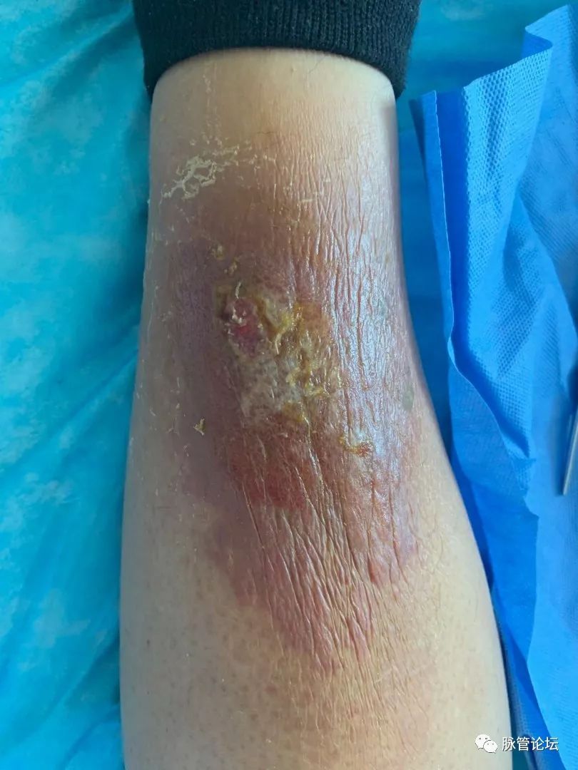 足癣丹毒是怎样引起的,痛风丹毒