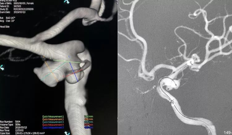 柳暗花明·第58期｜颅内动脉瘤栓塞时弹簧圈的选择（一）