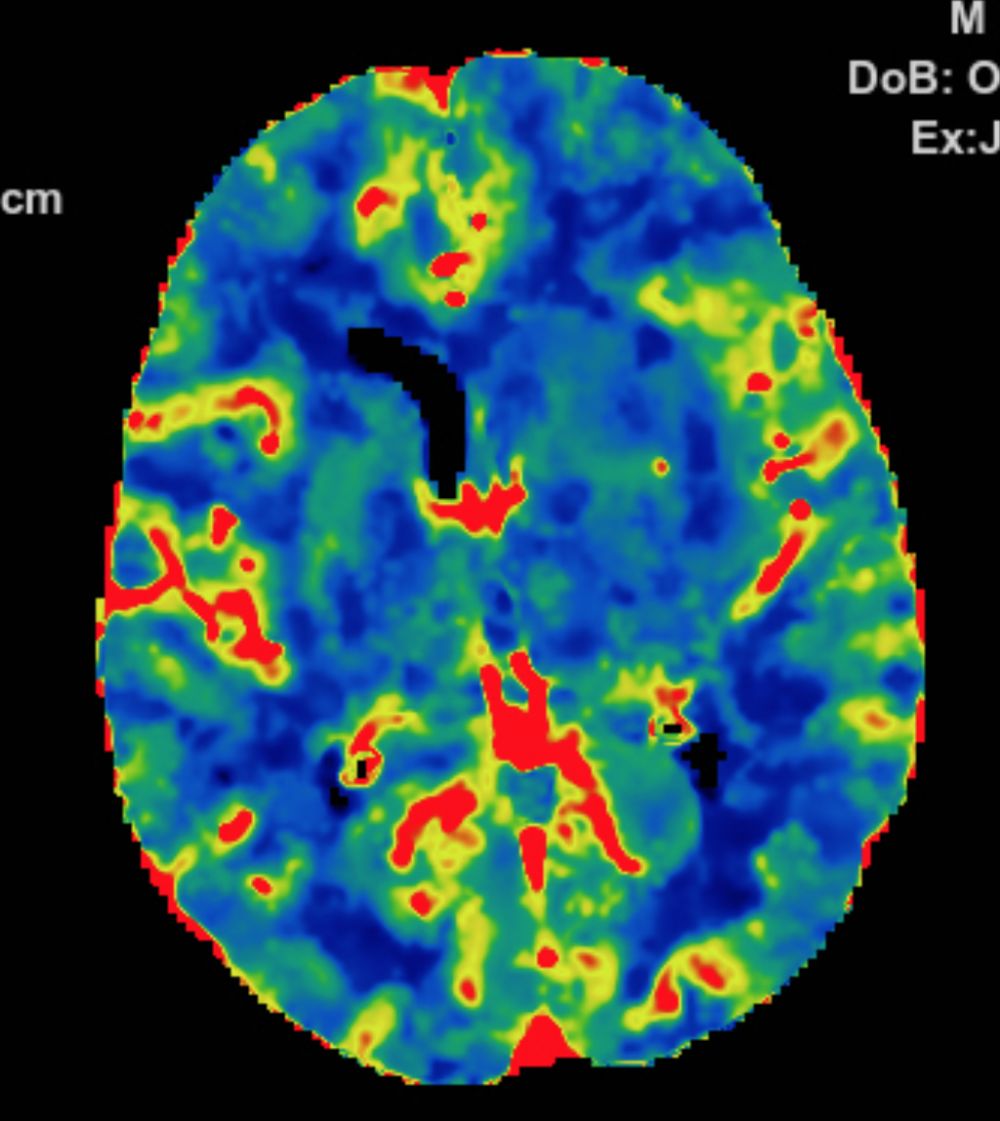 Reco特约·第10期｜国产组合助力取栓“一把通”——Ewata球囊导引导管联合Reco支架取栓分享