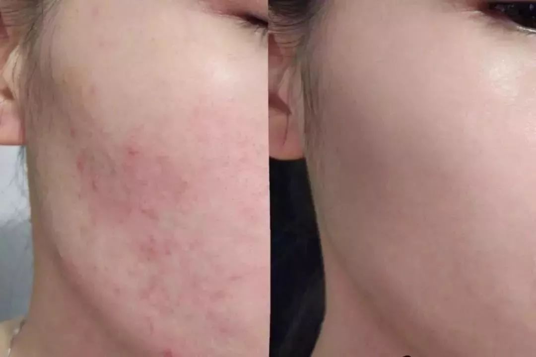 1分钱祛痘神器,祛痘神器0元领取