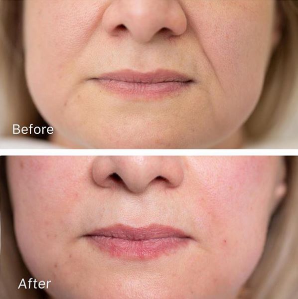 眼膜贴八小时紧致抗皱淡细纹,官方眼膜紧致抗皱淡细纹法令纹