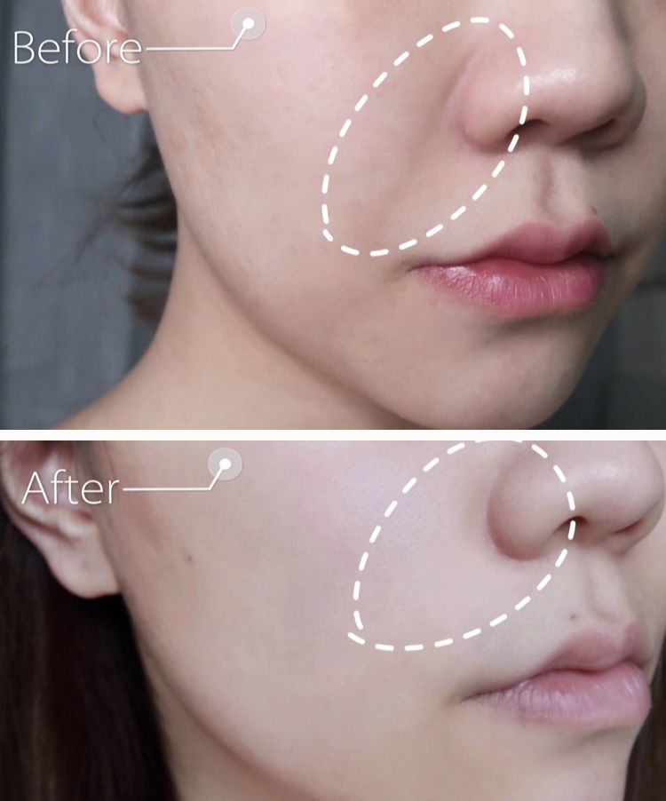 眉间纹和法令纹除皱针能去掉吗,嘴角纹法令纹抬头纹国货推荐