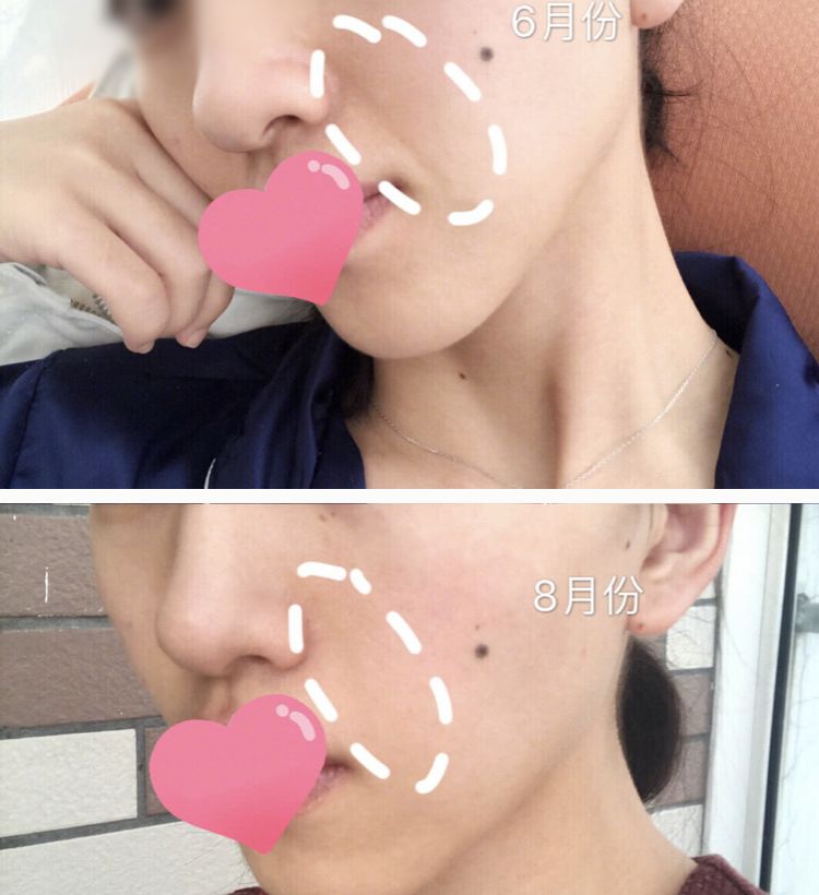 三十岁就有眉间纹法令纹怎么办,30岁法令纹眉心纹深