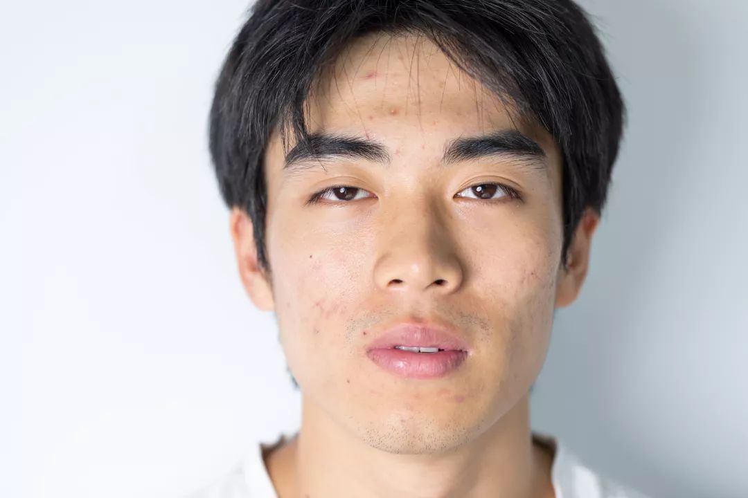 男士清理螨虫和黑头机器,男生青春痘黑头清洁神器