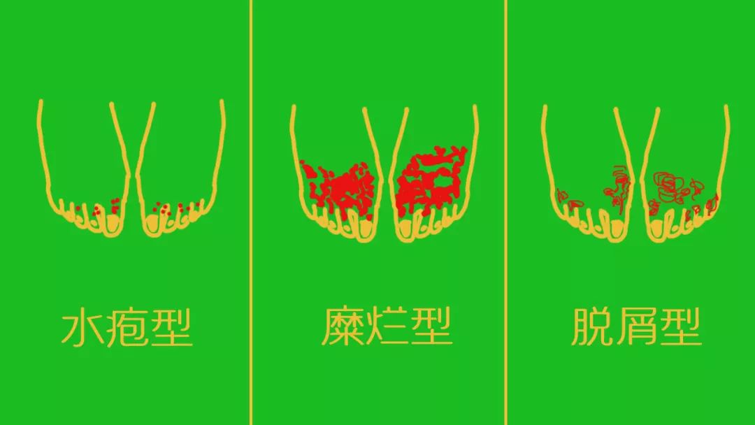 辟谣特工队|脚气——“踢不开的烦恼”