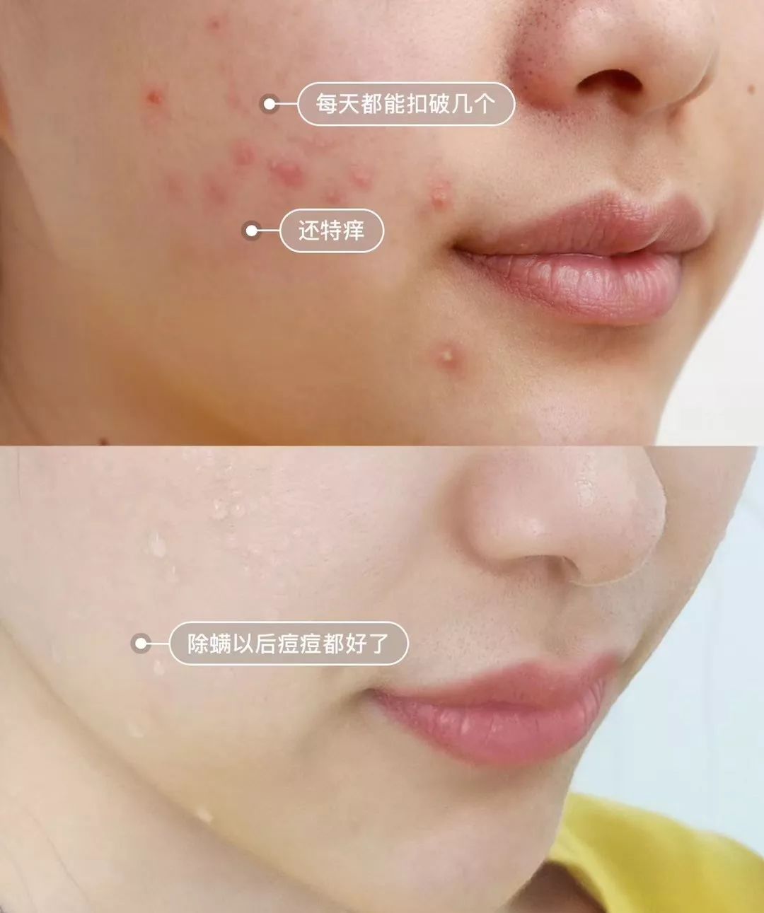 可美金箔祛痘螨虫皂,除螨皂能祛螨虫吗