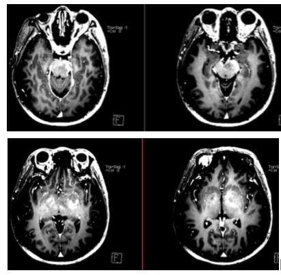 急性脂肪栓塞、神经白塞病、NMOSD极后区综合征丨3分钟读片·第11期