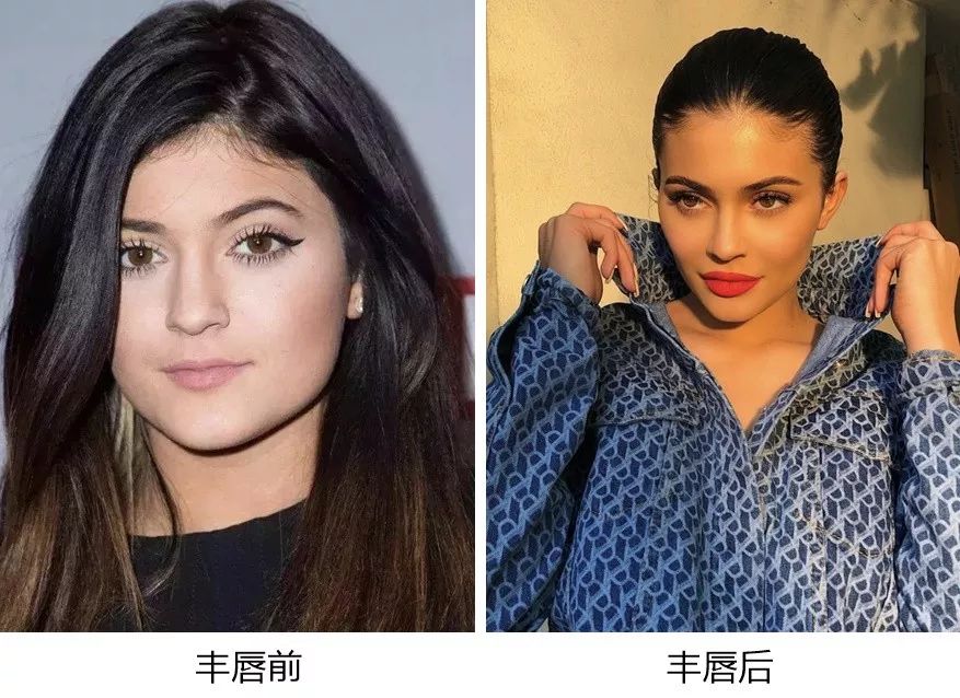 薄唇如何丰唇好看,丰唇使嘴唇变得更美