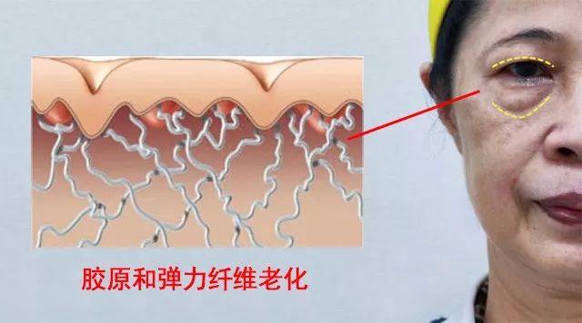 眼袋松弛下垂最快解决方法,严重眼袋下垂松弛怎么恢复